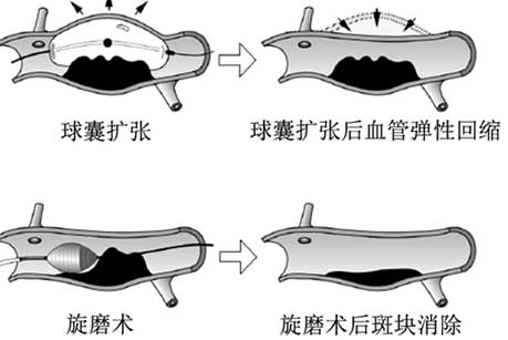 旋磨術示意圖.jpg